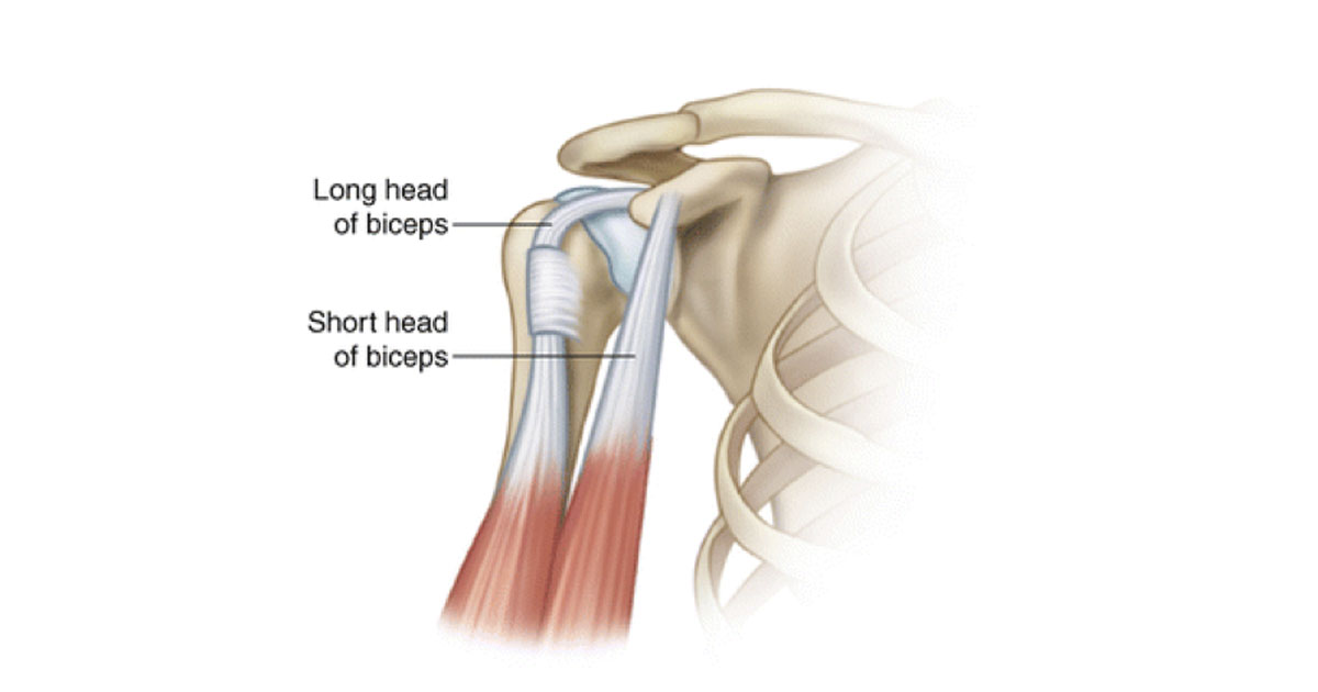 left long head biceps tendinopathy icd 10
