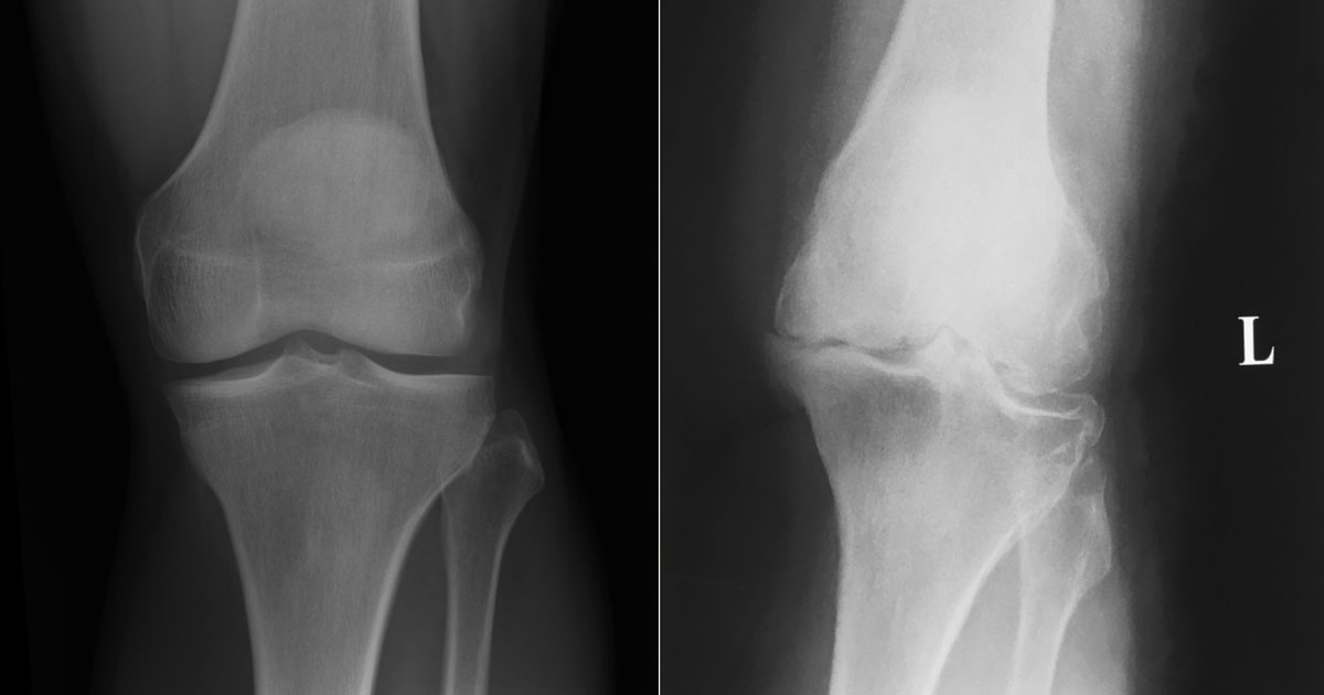 Osteoarthritis of the Knee