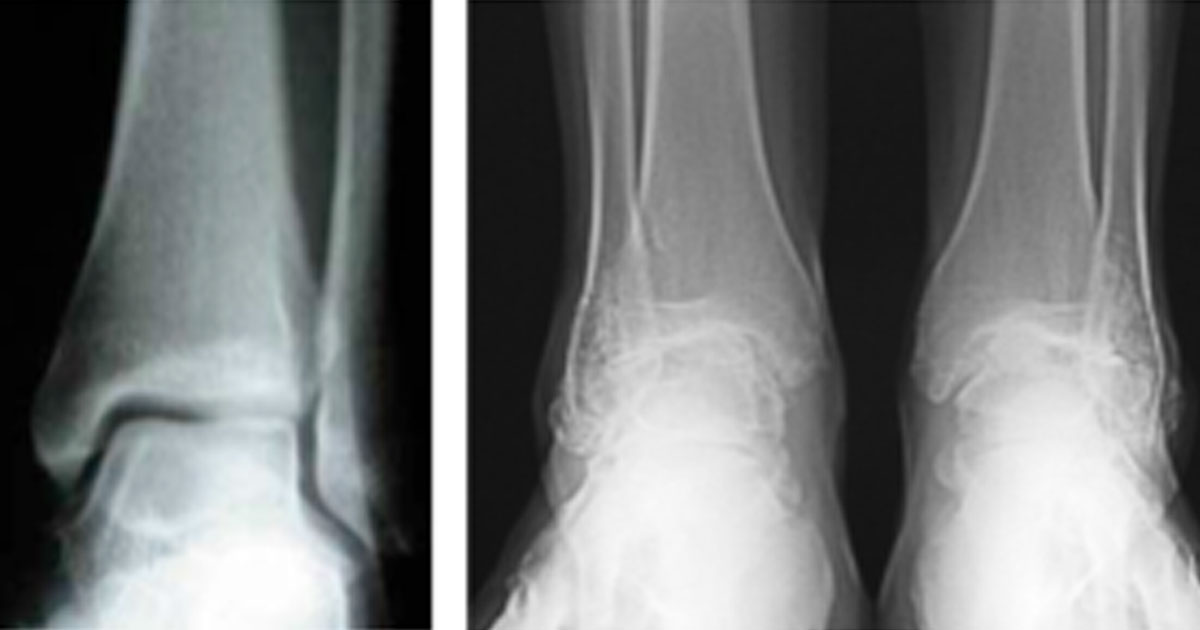 Ankle Osteoarthritis