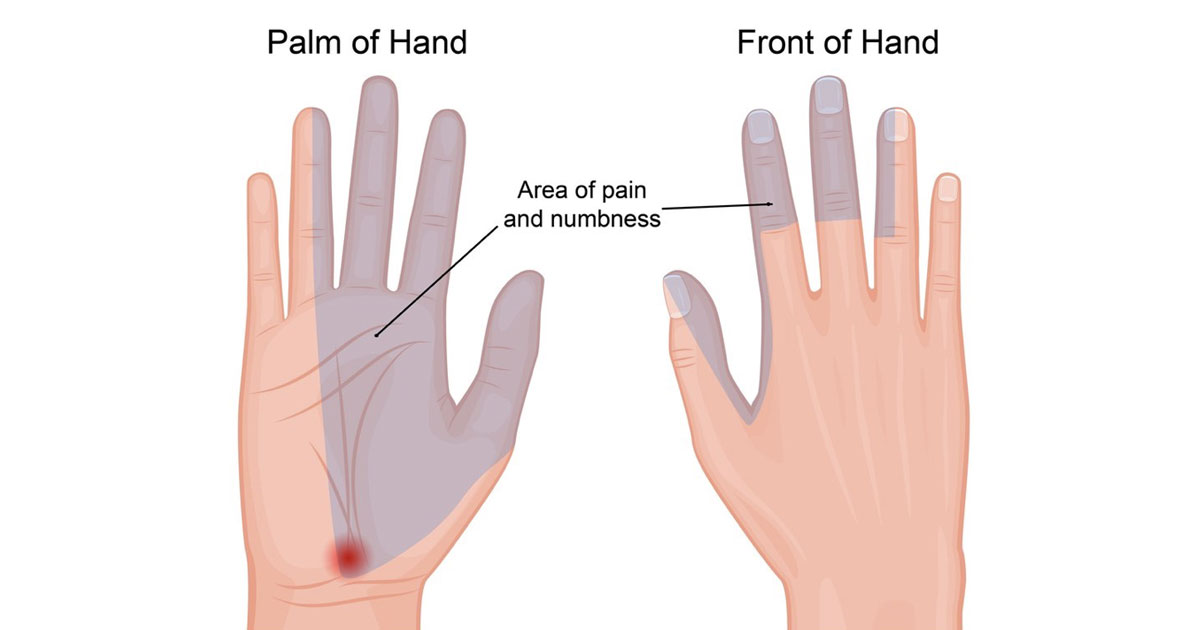 Carpal Tunnel Syndrome
