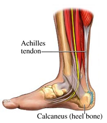 Achilles tendinopathy treatment Brisbane West End