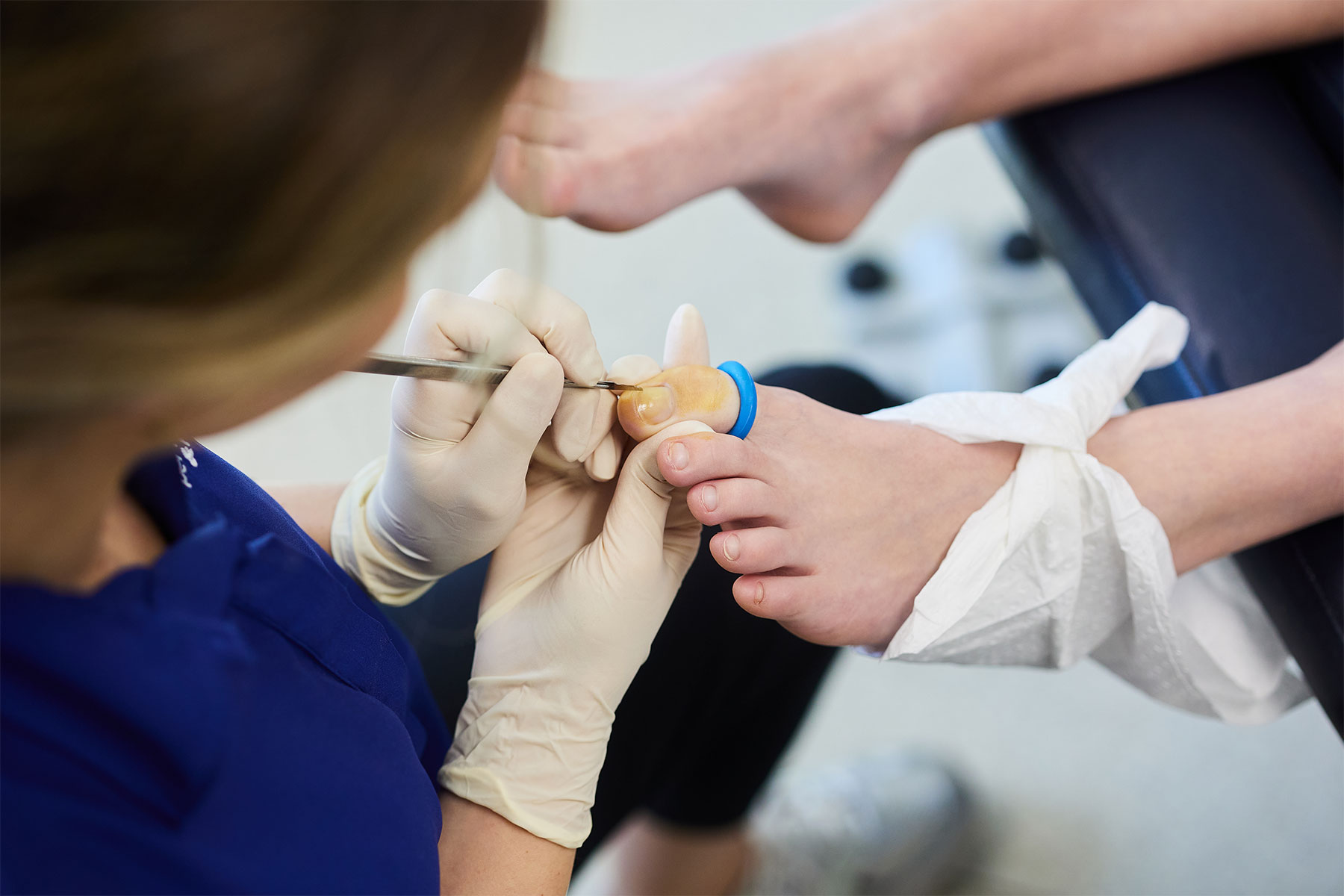 Corn and callus treatment West End Brisbane