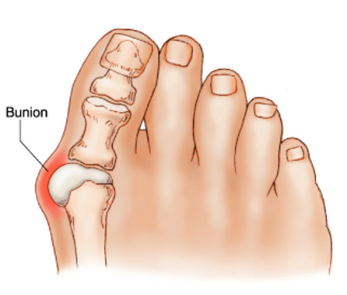 Bunion treatment Brisbane West End