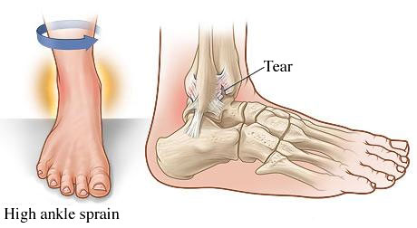 Bunion treatment Brisbane West End