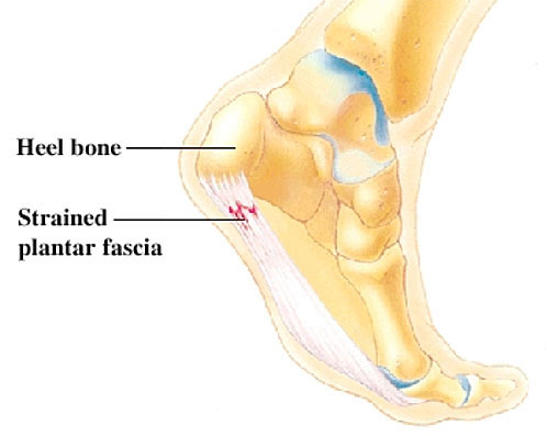 Plantar fasciitis treatment Brisbane West End