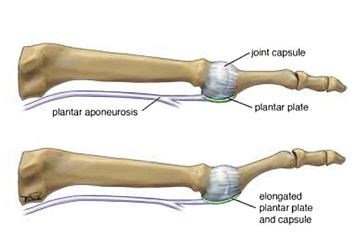 Plantar plate treatment Brisbane West End